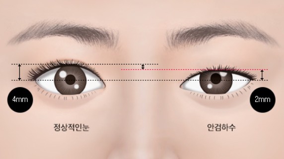 압구정서울성형외과 과연 쌍수만 한다고 달라질까? 관련 이미지 1