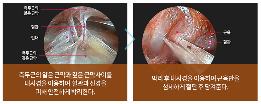 Anti-Aging at Apgujeong Seoul Plastic Surgery > Endoscopic Forehead Lift image 2