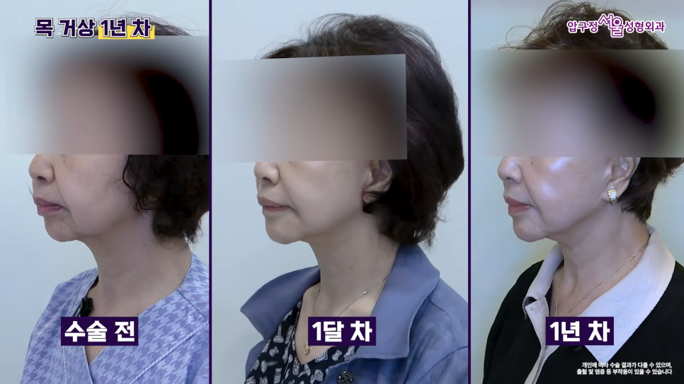 목거상 흉터 후기 목주름 수술 1년 후 변화 압구정서울성형외과 실제 사례로 알아보기 관련 이미지 7