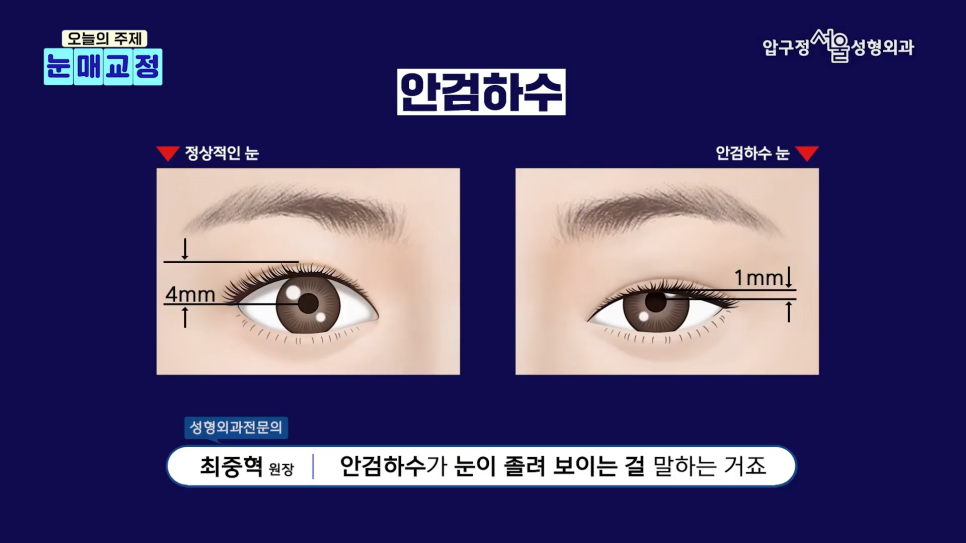 압구정서울성형외과 안검하수 수술 후기 비교│절개vs비절개 선택 기준 관련 이미지 3