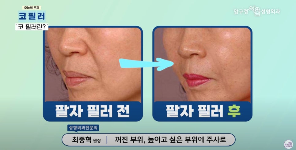 압구정서울 코필러 시술 후 코성형 가능할까요? 관련 이미지 2