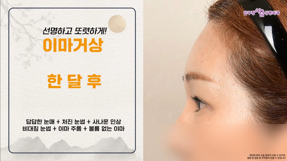 40대 이마거상수술 전후 궁금하다면? 내시경 이마거상술 체크포인트 관련 이미지 8