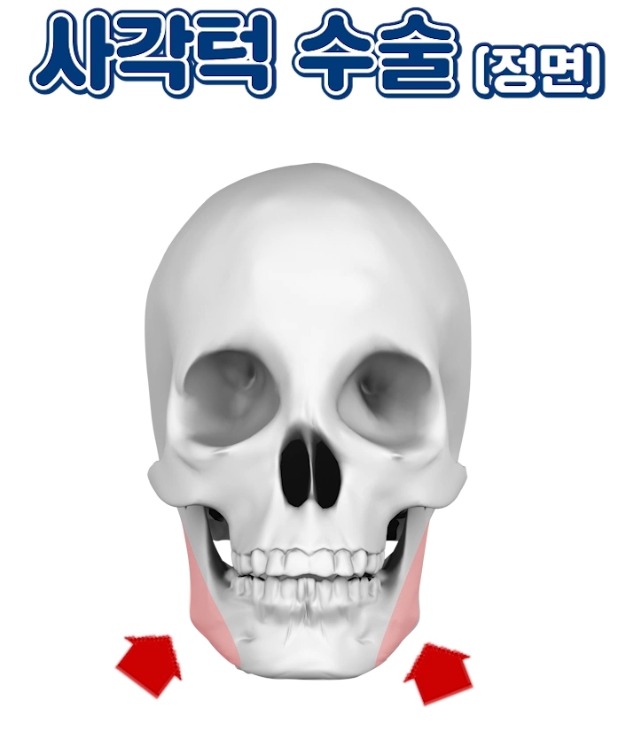 압구정 안면윤곽 사각턱, 광대, 턱끝 개념과 종류 수술방법 압구정서울성형외과 관련 이미지 17