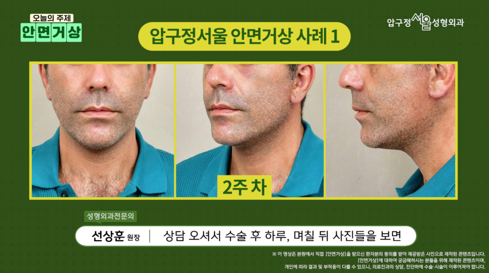Brad Pitt Facelift?! The Secret to Looking Younger: Youthful Plastic Surgery Facelift, Apgujeong Seoul Plastic Surgery image 8