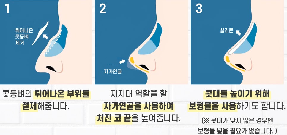 Apgujeong Seoul Plastic Surgery: Review of a Man’s Hump Nose and Bulbous Nose Surgery image 2