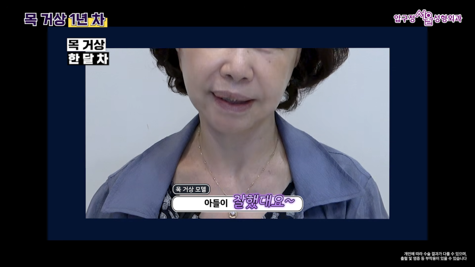 목거상 흉터 후기 목주름 수술 1년 후 변화 압구정서울성형외과 실제 사례로 알아보기 관련 이미지 4