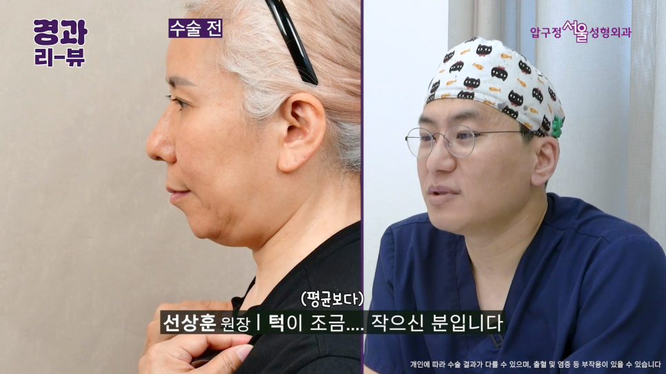 안면거상 전후 후기 압구정서울성형외과 실제 케이스 비교 분석 관련 이미지 3