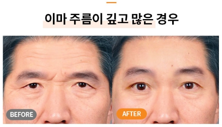Worried About Forehead Wrinkles? A Quick Overview of Men’s Forehead Lifts and Forehead Lift Surgery Costs image 8