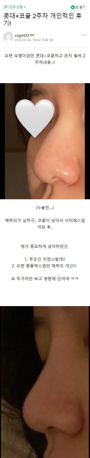 Escape from a Low Nasal Bridge at Apgujeong Seoul Plastic Surgery! image 5