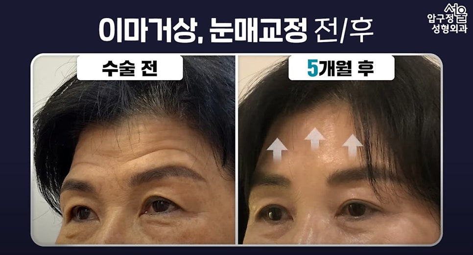 압구정서울성형 이마거상술로 이마주름 고민해결 후기 관련 이미지 6