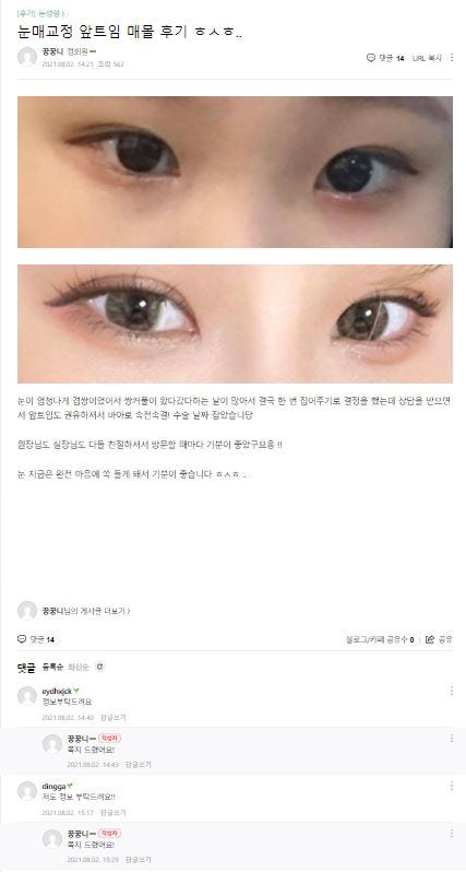 Lovely Eyes Are No Longer Difficult! [Apgujeong Seoul Plastic Surgery] image 4