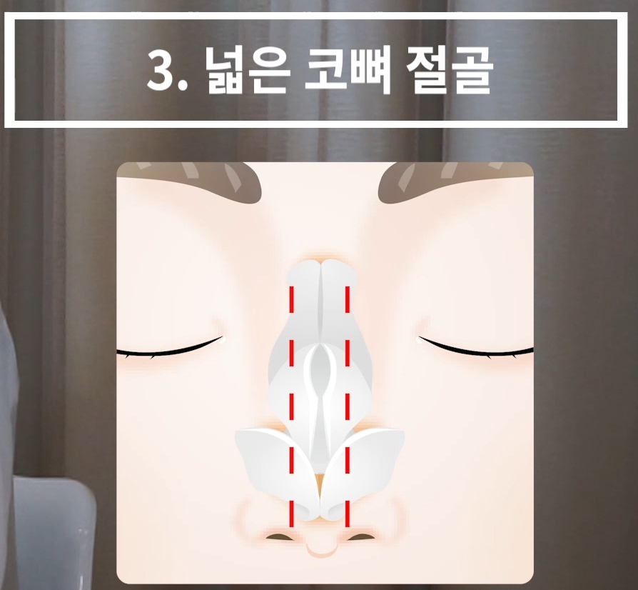 개방형 비개방형 코수술 차이점 장단점까지 한눈에 정리 관련 이미지 5