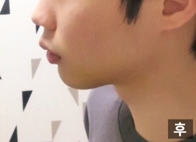 A Good Place for Chin Surgery: Apgujeong Seoul Plastic Surgery image 3