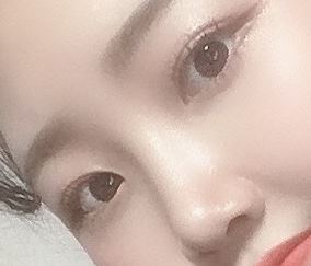 Customized Surgery by Nose Surgery Type, Fast Recovery, and a Good Place for Revision Rhinoplasty: Apgujeong Seoul Plastic Surgery image 8