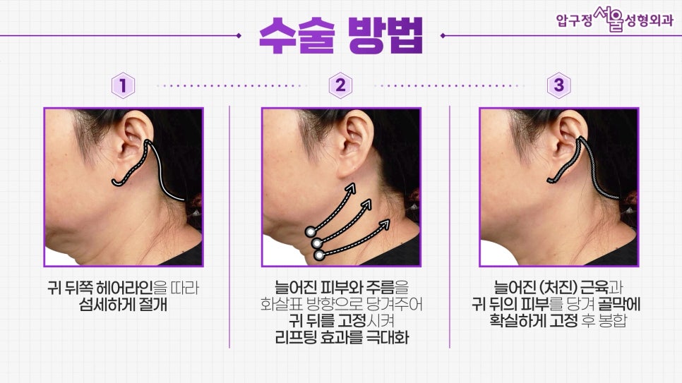 [목거상술 - 압구정 동안성형] 나의 목주름 유형은? 관련 이미지 6