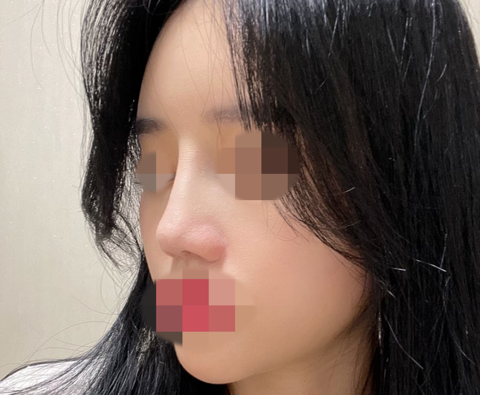 압구정서울성형외과 설윤 직선라인 자려한코성형 최중혁원장님 관련 이미지 6