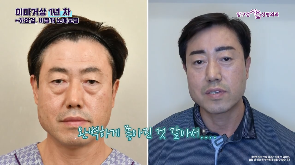 남자 이마거상 1년 후 실제 후기와 수술 전 알아야 할 핵심 포인트 관련 이미지 7