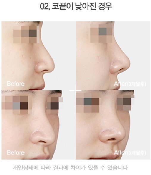 Apgujeong Seoul Plastic Surgery: Revision Rhinoplasty Methods by Type and Reviews image 5