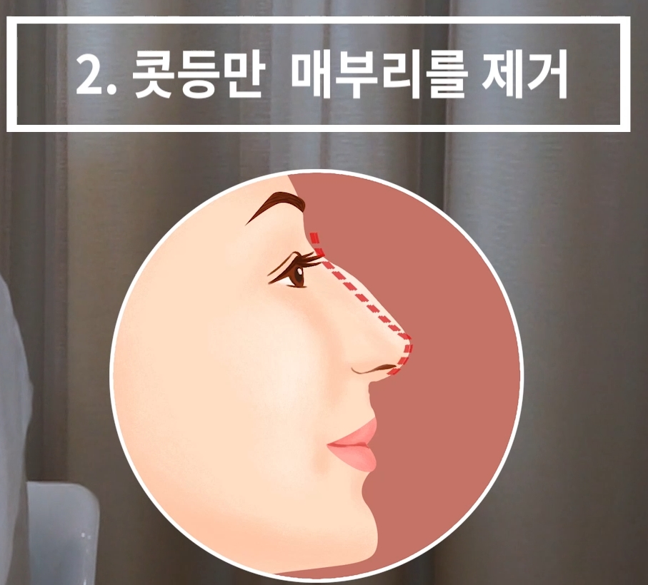 개방형 비개방형 코수술 차이점 장단점까지 한눈에 정리 관련 이미지 4