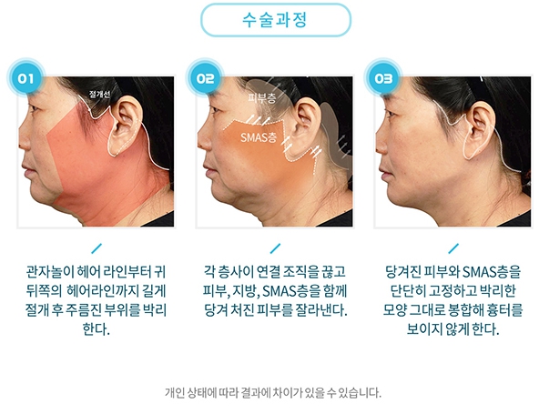 Curious About Reviews of a Clinic That Does Facelift Surgery Well at Apgujeong Seoul Plastic Surgery? image 3