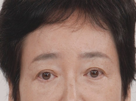 A Dramatic Transformation for Brighter, Clearer Eyes: A 5-Year Follow-Up Review of Forehead Lift Surgery in Your 60s image 12