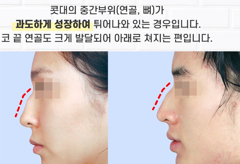 Apgujeong Seoul Plastic Surgery: Review of a Man’s Hump Nose and Bulbous Nose Surgery image 1