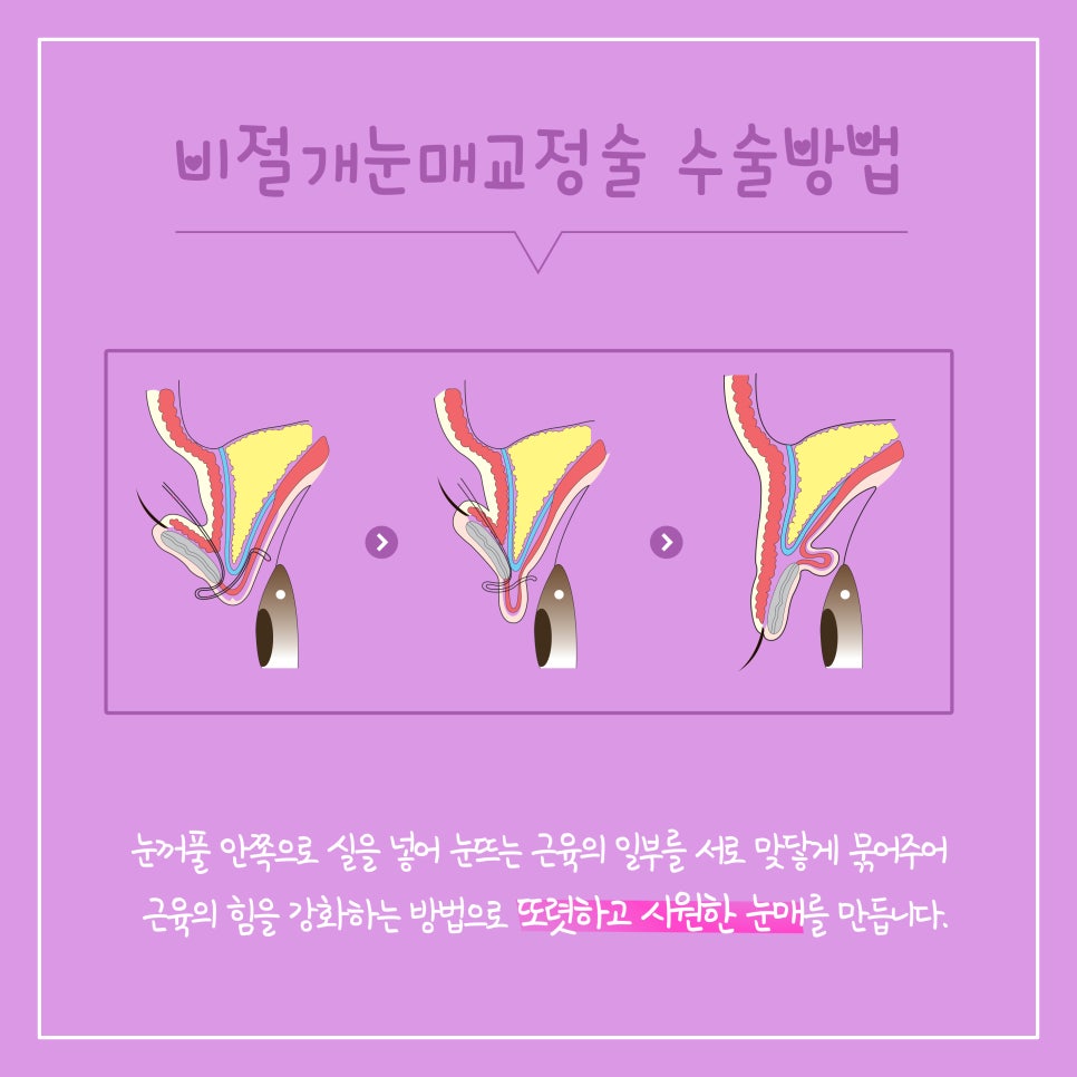 흉터 없이 크고 시원한 눈매를 만드는 비절개 눈매교정 관련 이미지 4