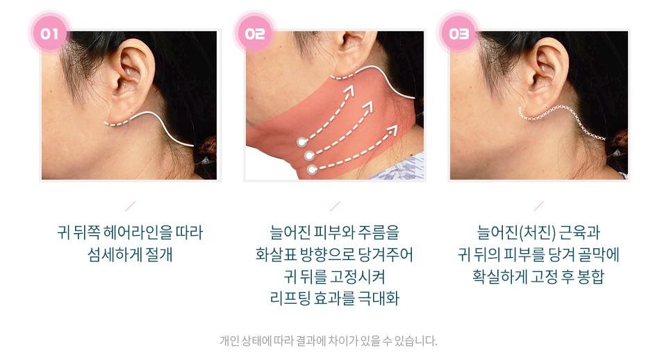 [압구정서울성형외과] 목주름과 처짐 목거상으로 깔끔한 개선! 관련 이미지 4