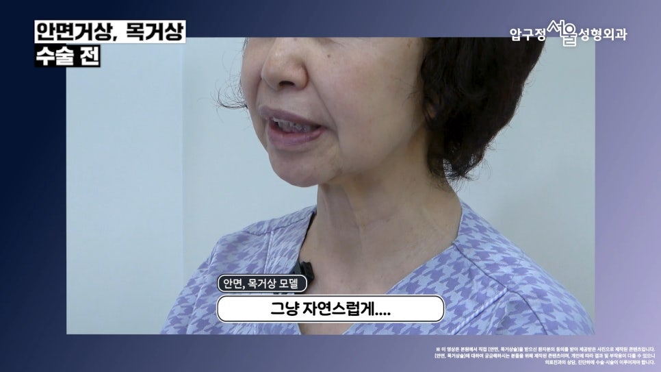 Before-and-After of Facelift and Neck Lift Surgery in Apgujeong: SMAS Facelift Case at Apgujeong Seoul Plastic Surgery image 3