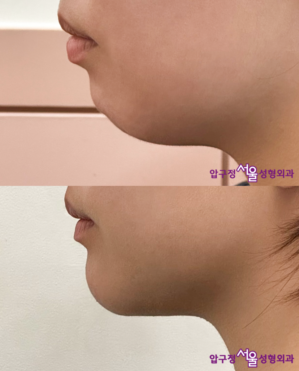 What Is a Retruded Chin? Chin Implant Surgery for Chin Correction at Apgujeong Seoul Plastic Surgery image 16