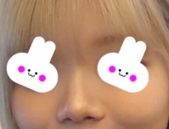 Apgujeong Bulbous Nose and Straight-Bridge Line Rhinoplasty Review image 1