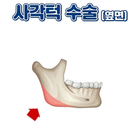 압구정 안면윤곽 사각턱, 광대, 턱끝 개념과 종류 수술방법 압구정서울성형외과 관련 이미지 15