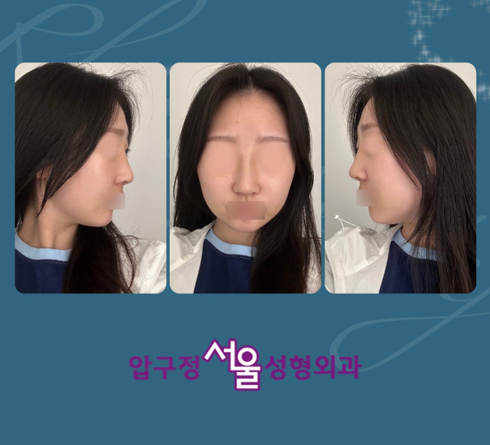 압구정성형외과 매부리코, 긴코성형으로 중안부 길이 축소 관련 이미지 8