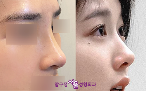 김유정 코, 눈수술(직반라인, 인아웃라인 쌍꺼풀) 연예인과 비슷하게 압구정서울성형외과 관련 이미지 11