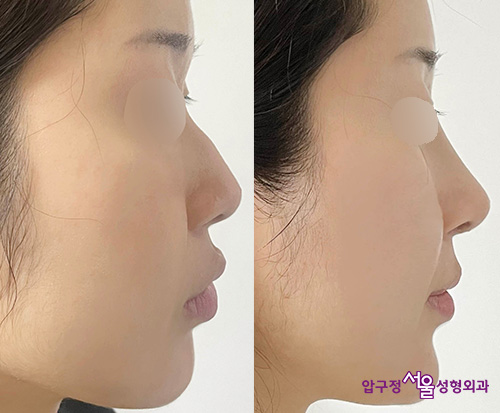 Natural Rhinoplasty Review for a Hump Nose with Septal Deviation in Apgujeong image 3