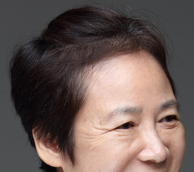 A Dramatic Transformation for Brighter, Clearer Eyes: A 5-Year Follow-Up Review of Forehead Lift Surgery in Your 60s image 4