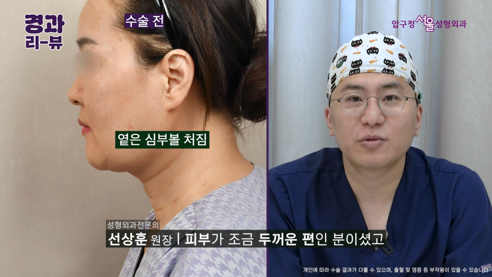 50대 안면거상 후기 팔자주름부터 목주름까지 어떻게 달라질까? 관련 이미지 2