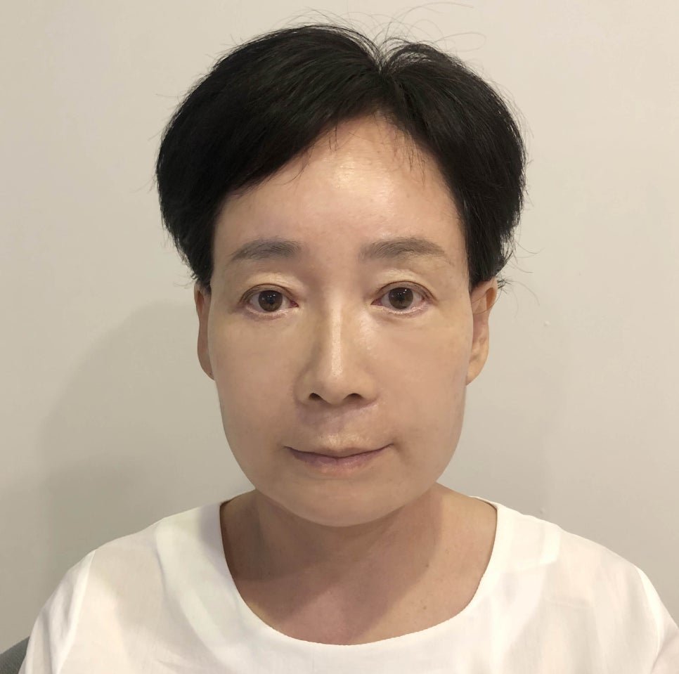 [다시, 청춘 프로젝트] 60대 안면거상, 목거상 상담 및 수술 후기 ③ 관련 이미지 5