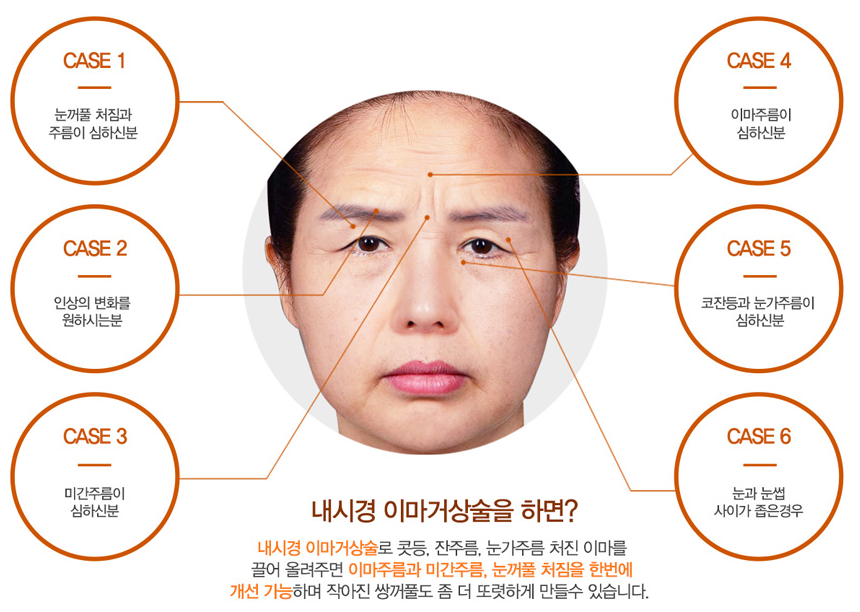 Anti-Aging at Apgujeong Seoul Plastic Surgery > Endoscopic Forehead Lift image 1