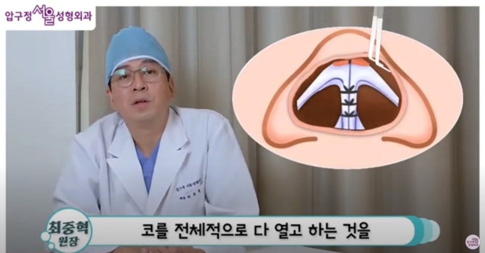 Apgujeong closed rhinoplasty: is it the right method for me? image 3