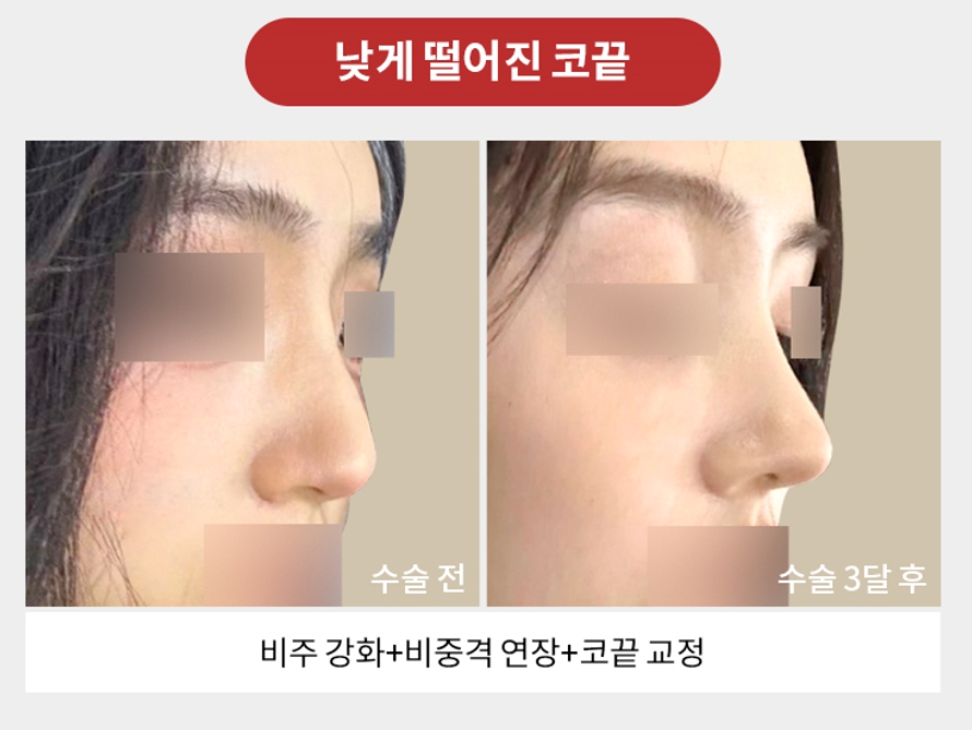 Revision Rhinoplasty Plastic Surgery: Female and Male Nose Surgery at Apgujeong Seoul Plastic Surgery image 6