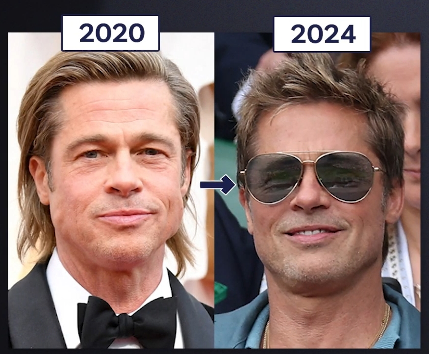 Brad Pitt Facelift?! The Secret to Looking Younger: Youthful Plastic Surgery Facelift, Apgujeong Seoul Plastic Surgery image 2