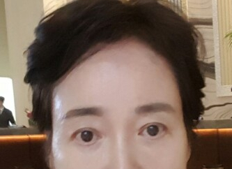 A Dramatic Transformation for Brighter, Clearer Eyes: A 5-Year Follow-Up Review of Forehead Lift Surgery in Your 60s image 7