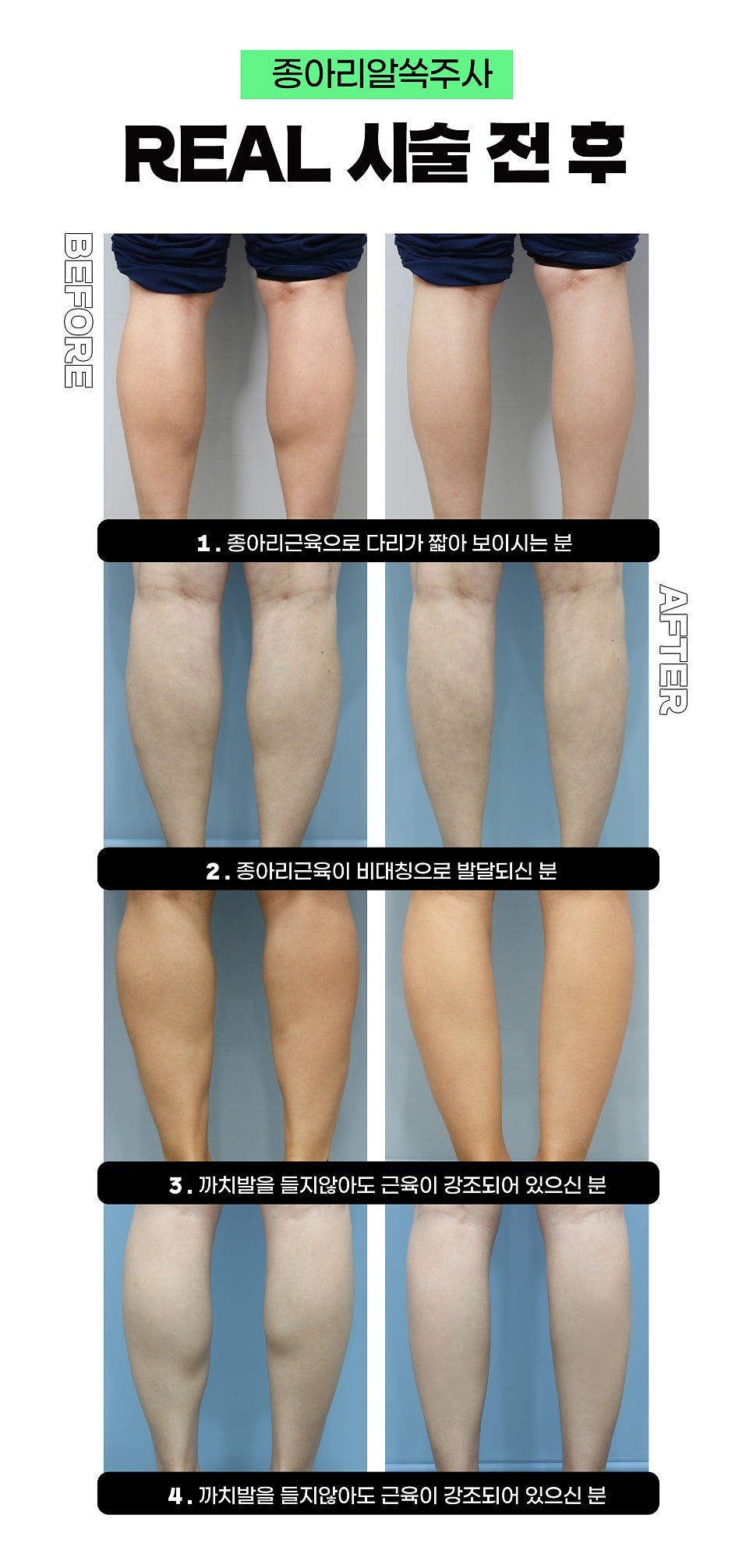 종아리알 유형별로 매끈하게 관리하기 관련 이미지 6