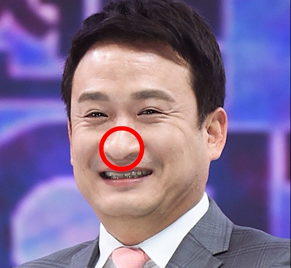 Naturally Improve a Drooping Nose Tip When You Smile with Arrow Nose Botox image 3
