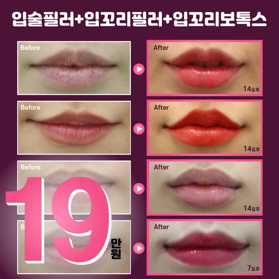 홍대피부과, 키스데이맞이 입술필러 이벤트 관련 이미지 2