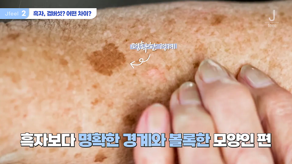 기미 주근깨 잡티에 이 시술만은 NO! 시술 전 필독 관련 이미지 4