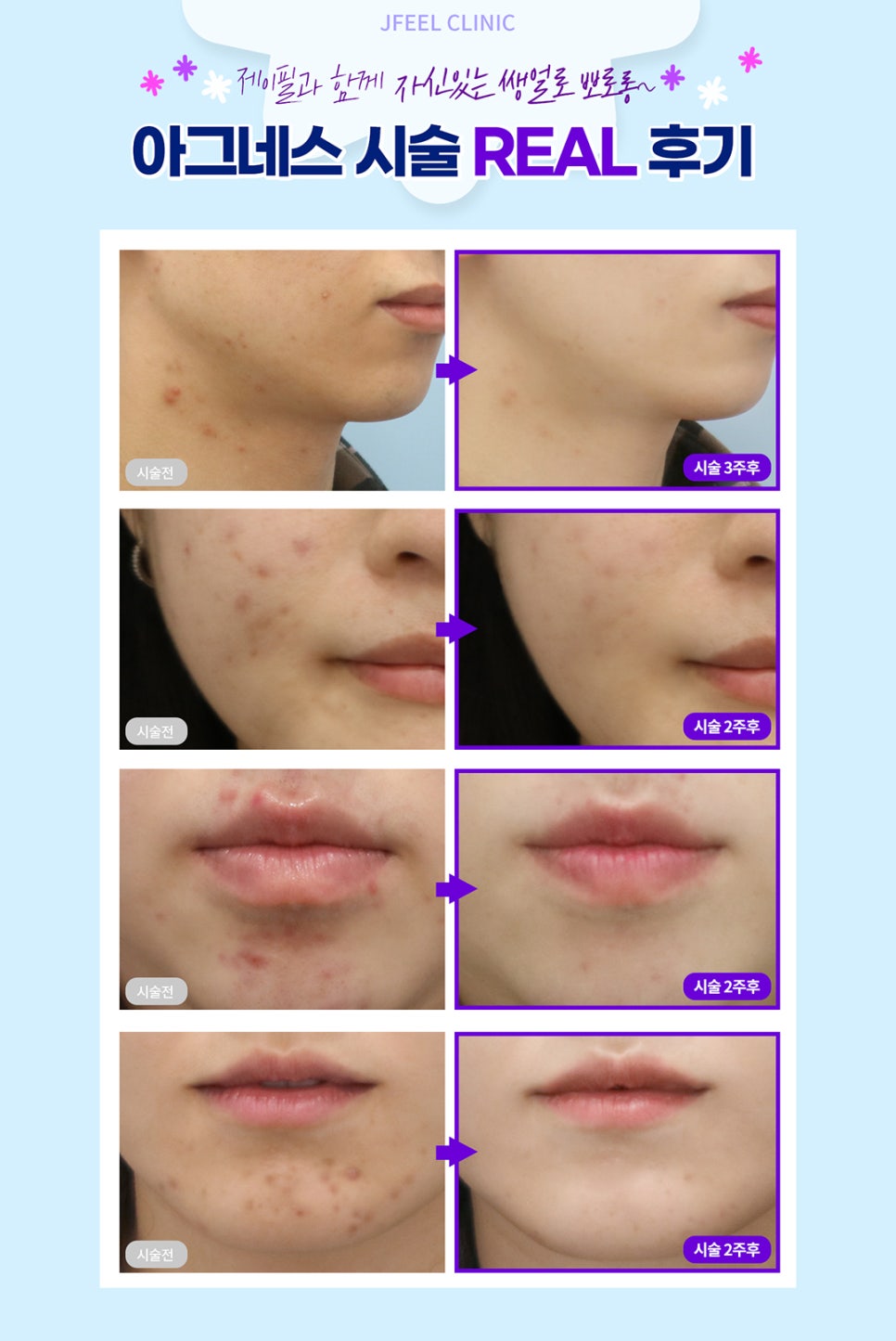 마스크트러블,마드름 제대로된 여드름치료는 아그네스로 관련 이미지 6
