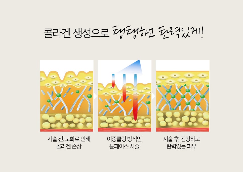 튠라이너 & 튠페이스 시술, 어떤 효과 있을까? 리프팅 + 탄력 관련 이미지 17