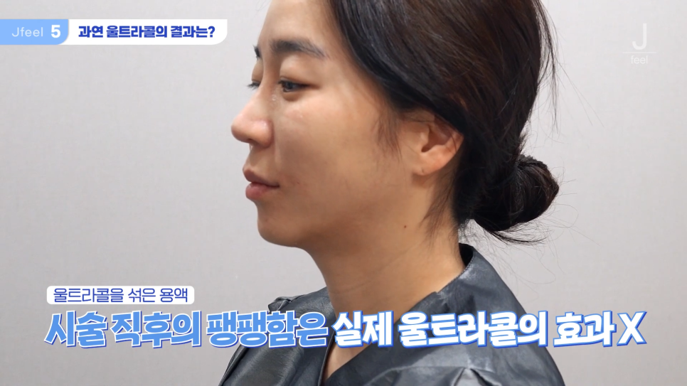 필러가 싫다면? 눈가, 팔자, 주름 해결하는 울트라콜 관련 이미지 13